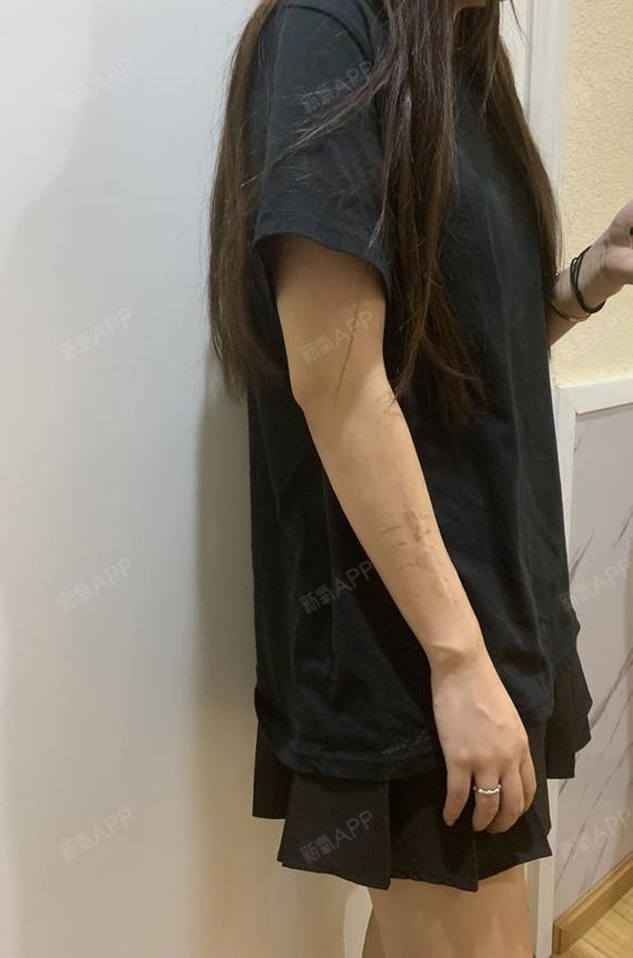 【成都军建医院疤痕华西疤痕研究院-手术疤痕】经过两_圈子-新氧美容