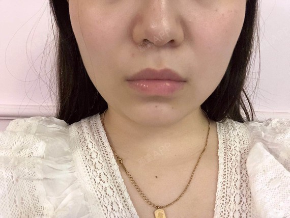 瘦脸针的效果真的是_圈子-新氧美容整形