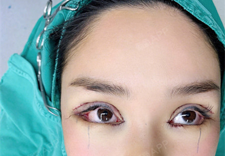 就不用在乎别人的看法,我自己做的就是做的眼部多项项目;切开双