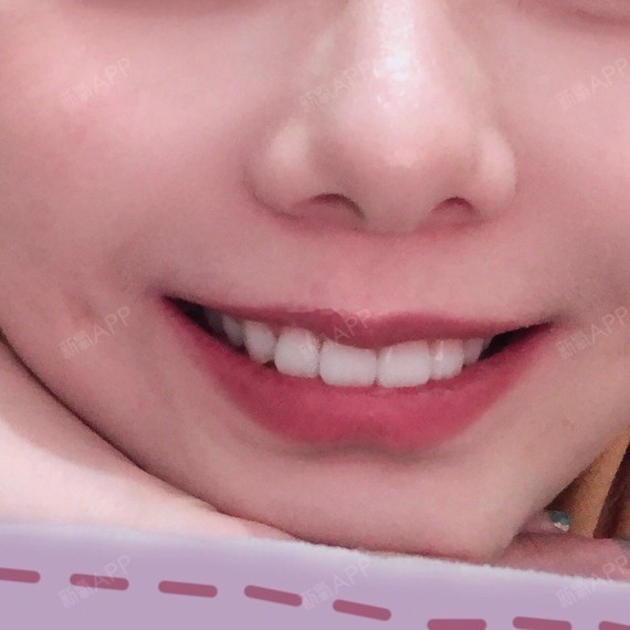 牙齿正畸篇刚上大学的时候戴的牙套吧,这个寒