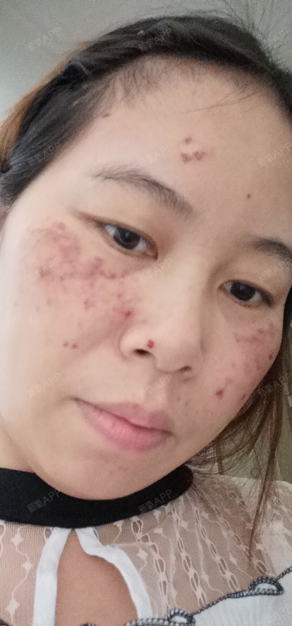 深圳皮秒激光好不好_效果图_冷水氧气皮秒激光术后第3天_新氧美容整形