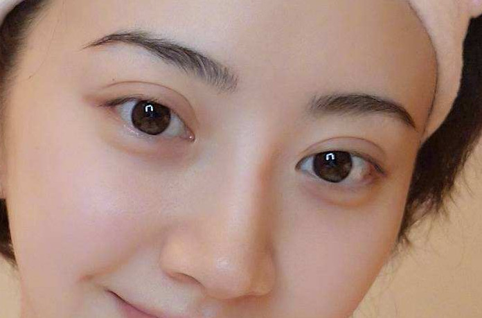 双眼皮术后过宽,肉条明显,全切双眼皮一年,修复难度大吗?