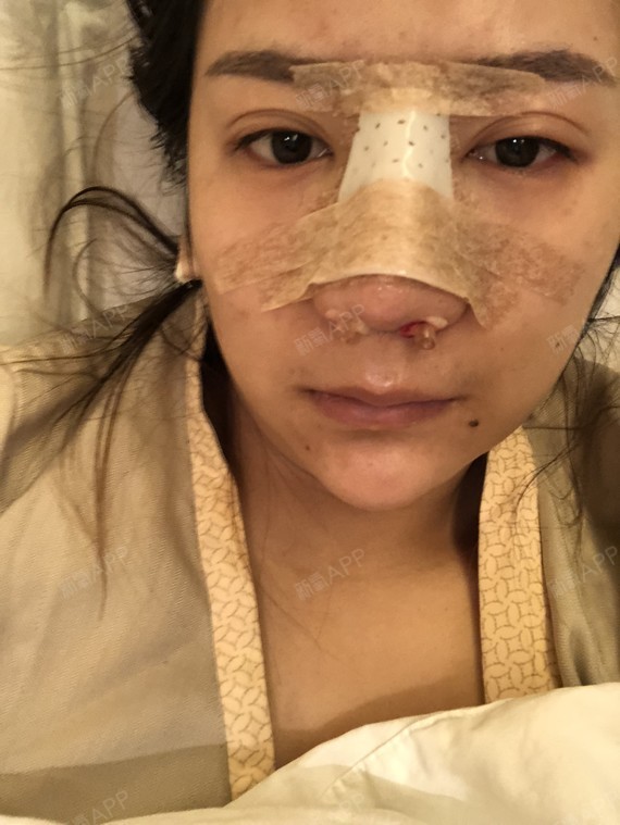 这是手术当天,麻药效果过后我就醒了,而且活力满满的_圈子-新氧美容