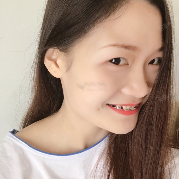 我戴的牙套是最原始的「不锈钢托槽」,优点:价格最便宜,见效最快.