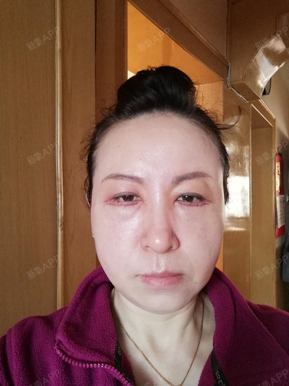 今天是在家换了药,打算去拆线呢,看着还有点小恐怖