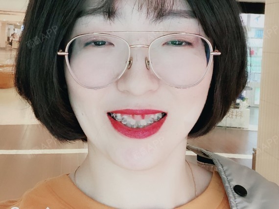 老阿姨正畸,北大口腔,自锁钢牙~11.