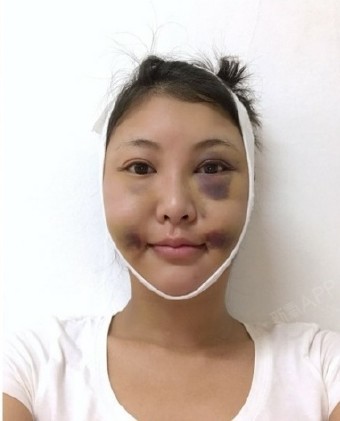 拍照时根本无角度可抓,真是怎么拍怎么大, 我的情况主要是颧骨高而且