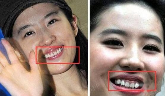 但是笑起来似乎就开始不太对了,这门牙上的牙龈怎么就看着有点多呢?