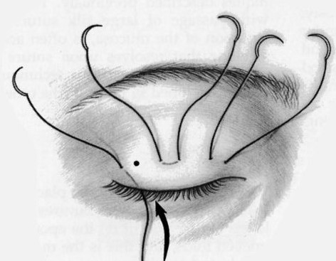 眼皮手术需要恢复多久?双眼皮手术恢复时间是