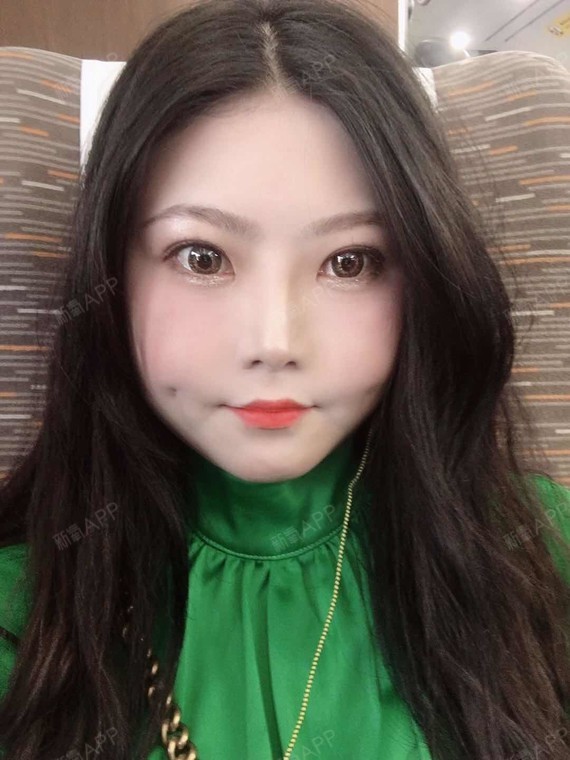 酒窝成形术好不好_效果图_行走的小芒果酒窝成形术术后第123天_新氧