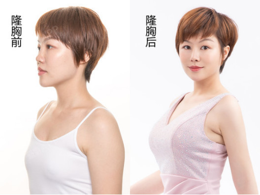 漂亮的乳房体积是由胸部五大黄金线决定的,隆胸手术必须严格按照人体