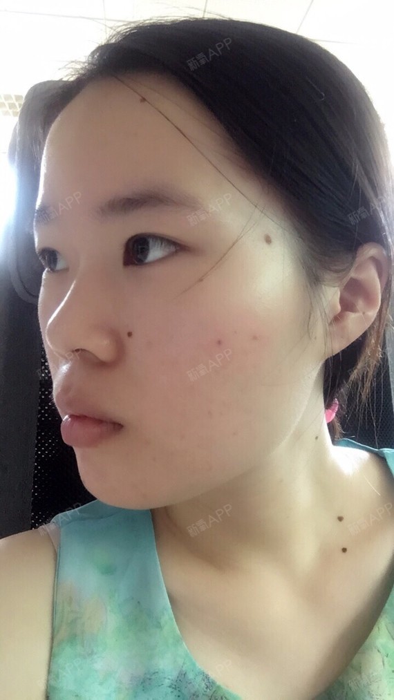 打完瘦脸针有半个月了吧,感觉脸是瘦了一些呢,但还没_圈子-新氧美容