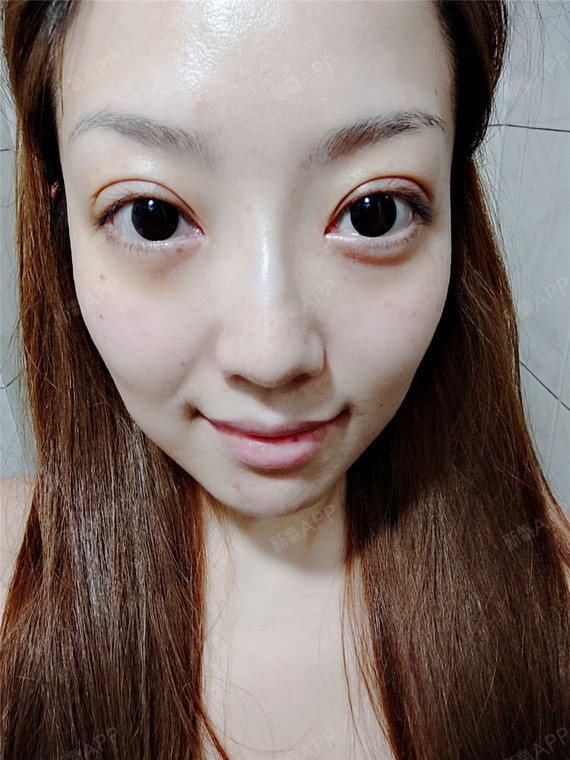 现在双眼皮层次感很强,眼皮有点厚(还有些微肿),看_圈子-新氧美容整形