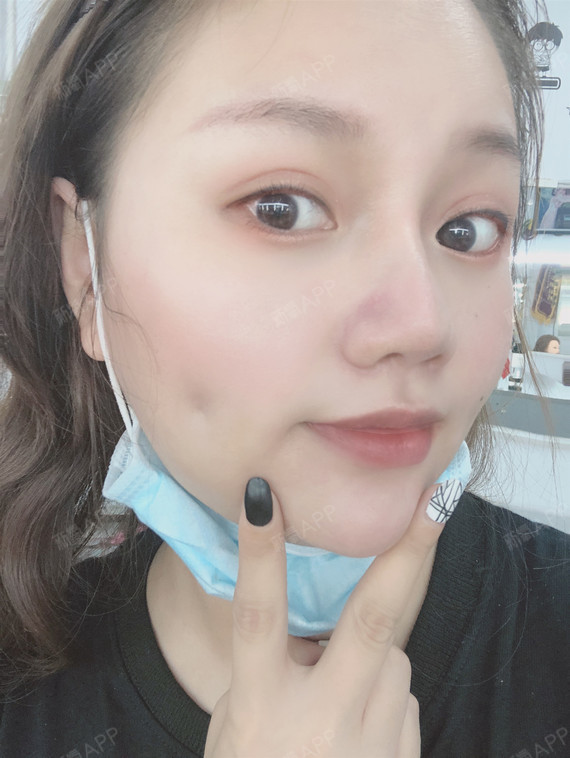 第五天,现在还能看到酒窝术后的痕迹,总的来说,恢复_圈子-新氧美容