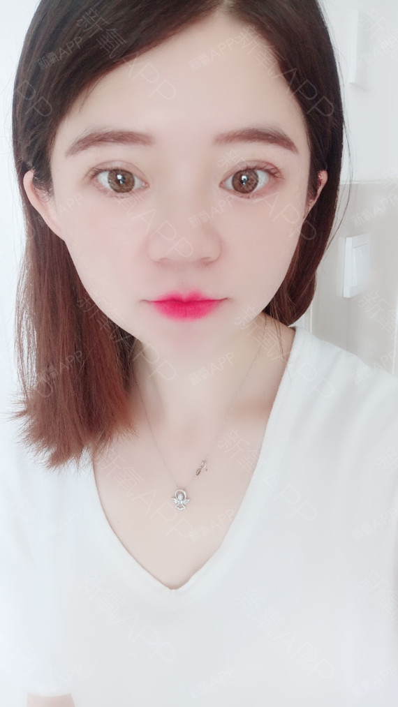 我觉得我做完双眼皮之后眼睛变成了圆的大家都说挺可爱的双眼皮恢复的