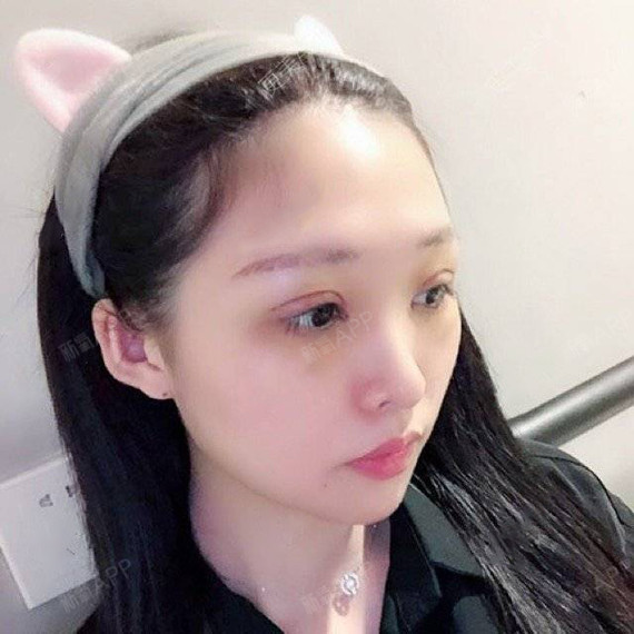 建议各位选择双眼皮呢,一定要做夸张的夸张的夸张的!