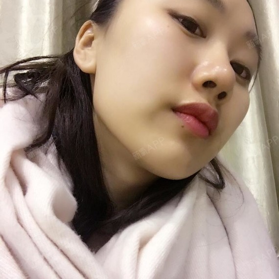打了瘦脸针都两个月了,这是我第一次瘦脸针,太满意啦_圈子-新氧美容