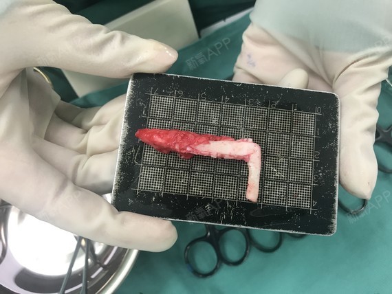 (取出的l型硅胶假体)