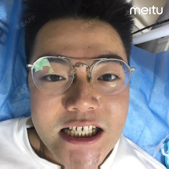 牙贴面超瓷贴面牙齿美白男生美牙案例全脸对比90别人已_圈子-新氧