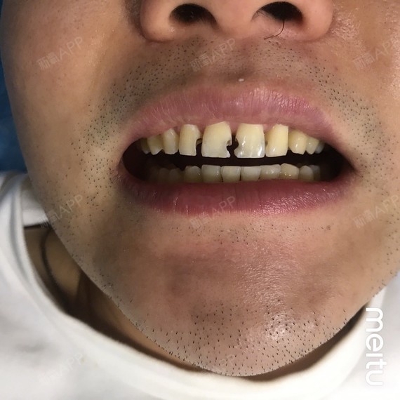 牙贴面 超瓷贴面 牙齿美白男生美牙案例