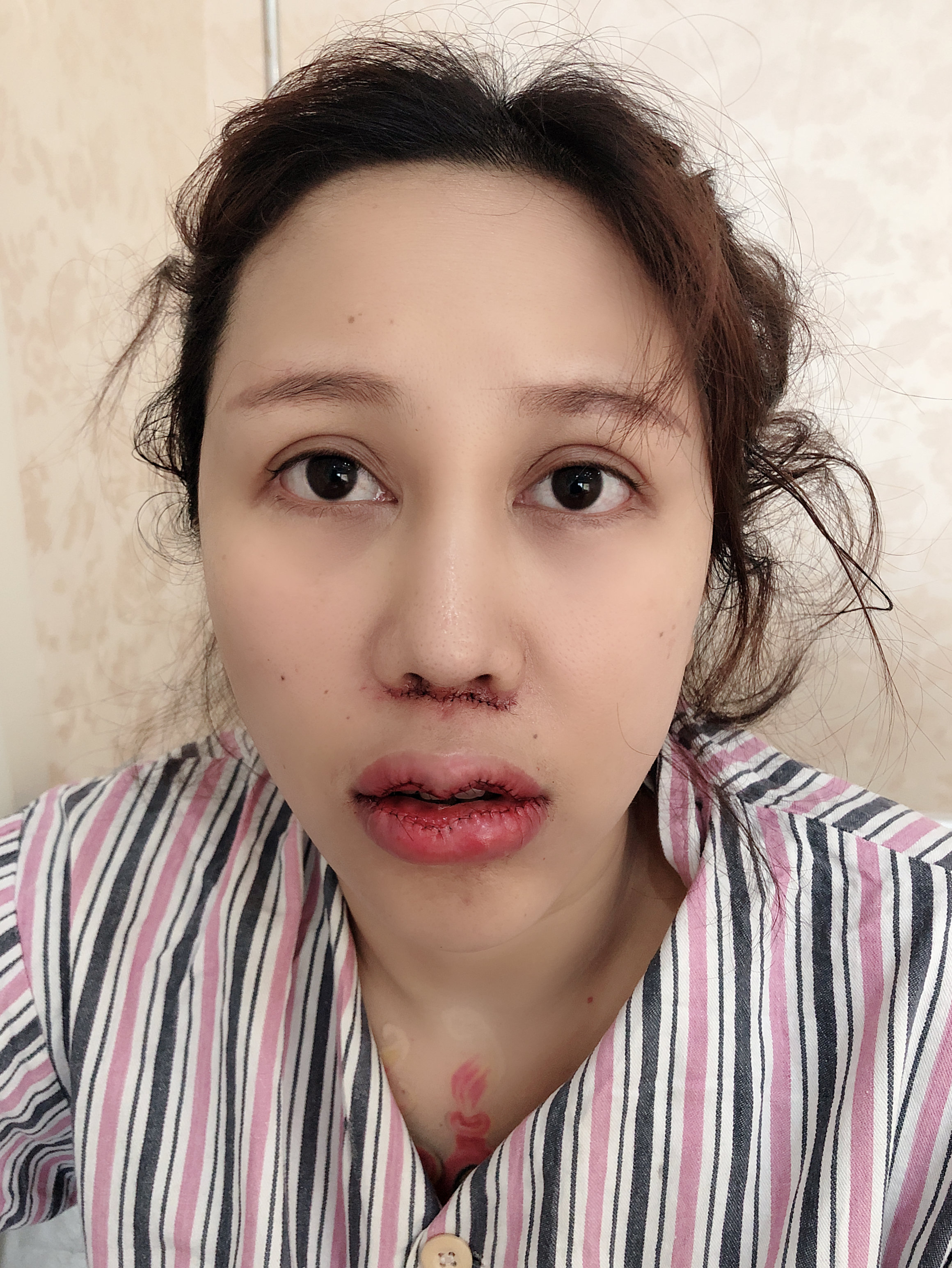 人中缩短术和厚唇改薄第五天啦看到自己的蜕变真的很开心