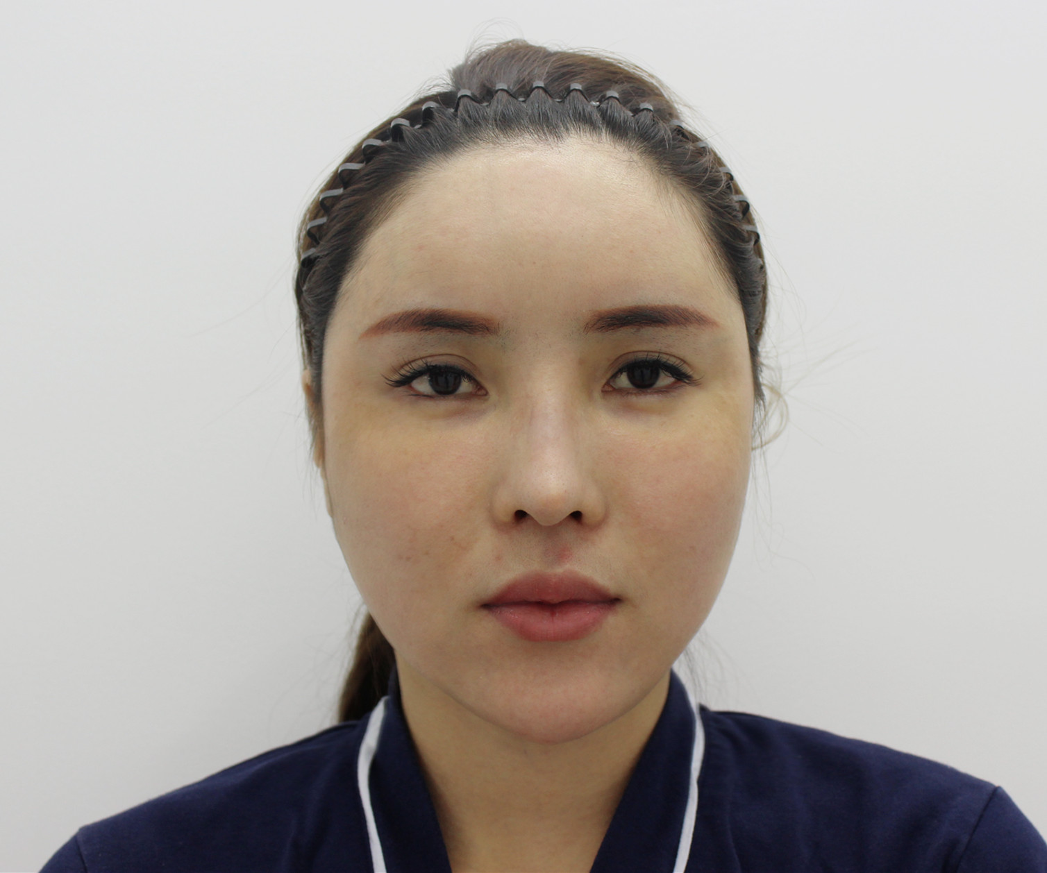 自体脂肪填充后凹凸不平是什么原因?怎么修复?