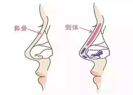 科普|隆鼻假体哪种好?深度揭秘硅胶和膨体之争