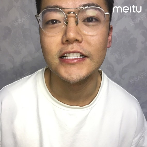 牙贴面超瓷贴面牙齿美白男生美牙案例全脸对比90别人已_圈子-新氧