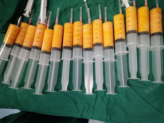 您好,自体脂肪隆胸在目前来说已经是非常成熟