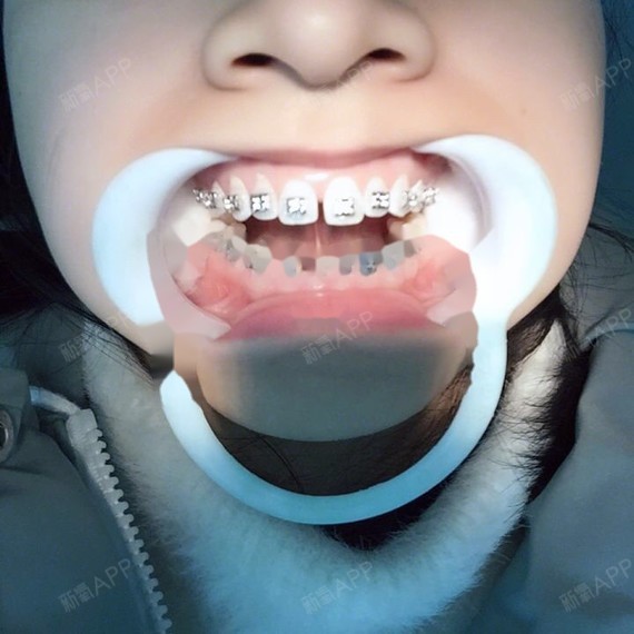牙齿稀疏矫正牙缝大钢丝牙套正畸#广州_圈子