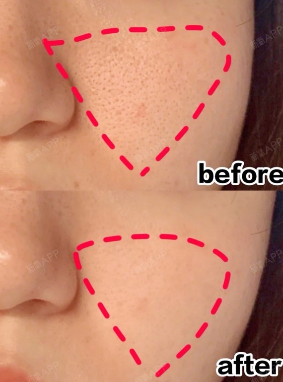 【草莓鼻 草莓脸拯救方法】控油 收缩毛孔