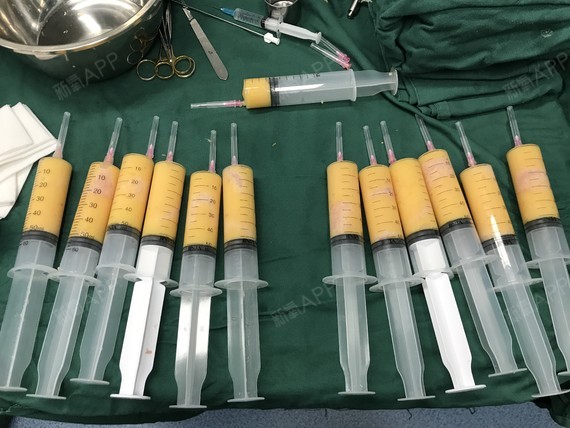 您好,自体脂肪隆胸在目前来说已经是非常成熟