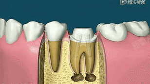 "拔牙髓"≠根管治疗