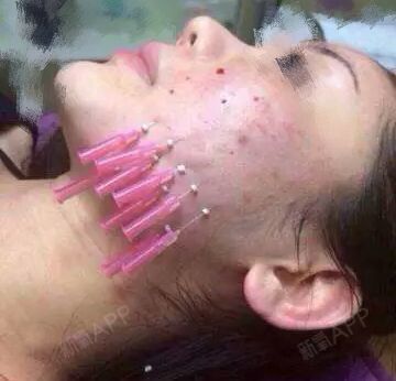 面部蛋白线提升除皱忌什么?线雕2年后会比现在老吗?