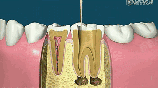 1,蛀牙坏到牙齿内部,牙髓或细菌感染引起了急/慢性牙髓炎 2,牙髓由于