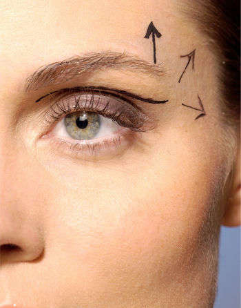假体眉弓手术都适合哪些人呢 新氧美容整形