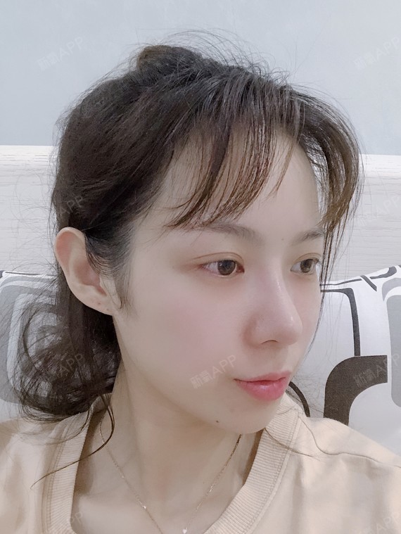 耳软骨复合隆鼻好不好_效果图_我不是宝宝的宝宝耳软骨复合隆鼻术后第