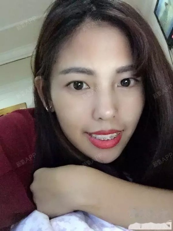 有没有跟我一样牙槽骨不平的牙套友?而且上嘴唇短