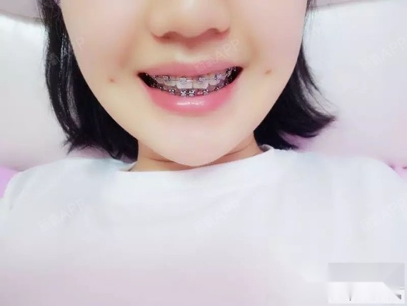 戴上牙套之后脸型发生变化,整个人变丑,原来说戴牙套_圈子-新氧美容