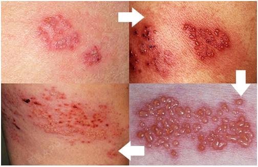 【德汉斯】-带状疱疹