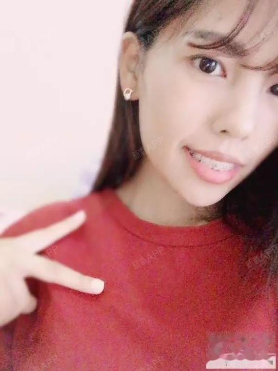 有没有跟我一样牙槽骨不平的牙套友?而且上嘴唇短