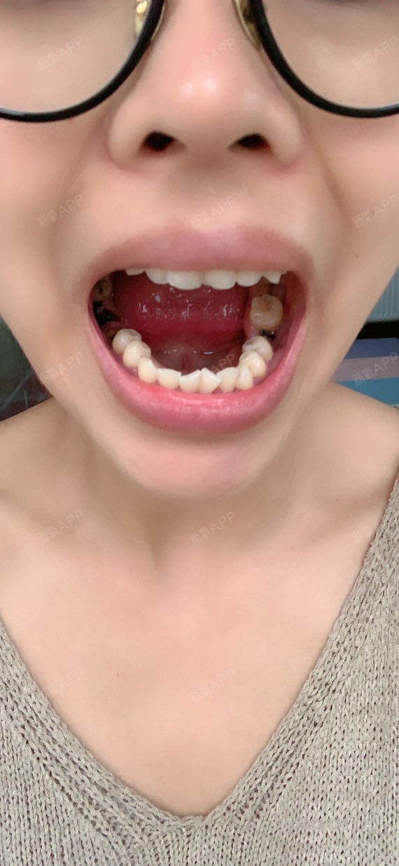 我的牙齿你们可以看我术前,咬合面不齐,还有虫牙地方_圈子-新氧美容