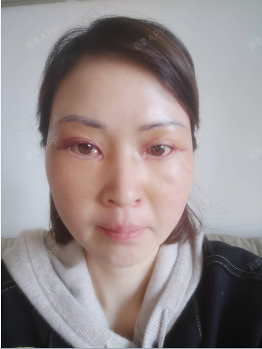 成都内切去眼袋好不好_效果图_红红酒妹内切去眼袋术后第5天_新氧美容