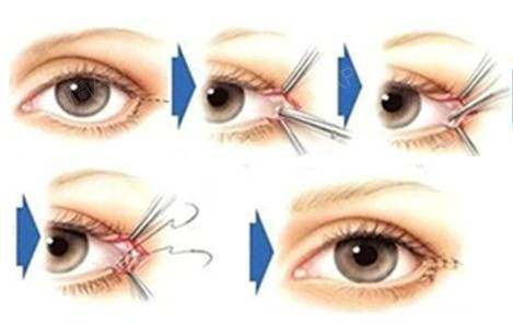 手术主要方法 ▼图示开外眼角过程