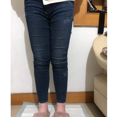 【青岛凛香-吸脂瘦腿术后第27天】现在正常跑步已经_圈子-新氧美容