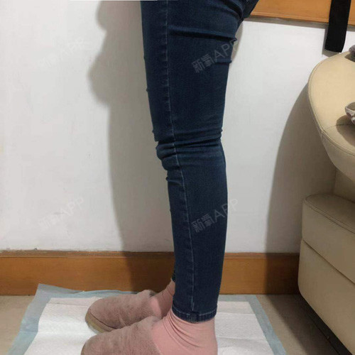 【青岛凛香-吸脂瘦腿术后第27天】现在正常跑步已经_圈子-新氧美容