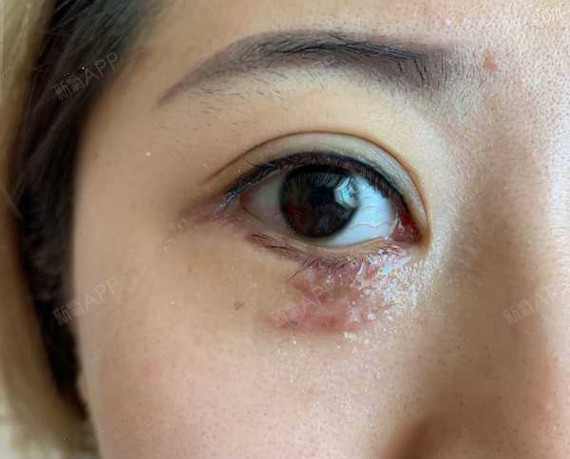 昆明无创疤痕修复好不好_效果图_氧气zsg0z无创疤痕修复术后第8天