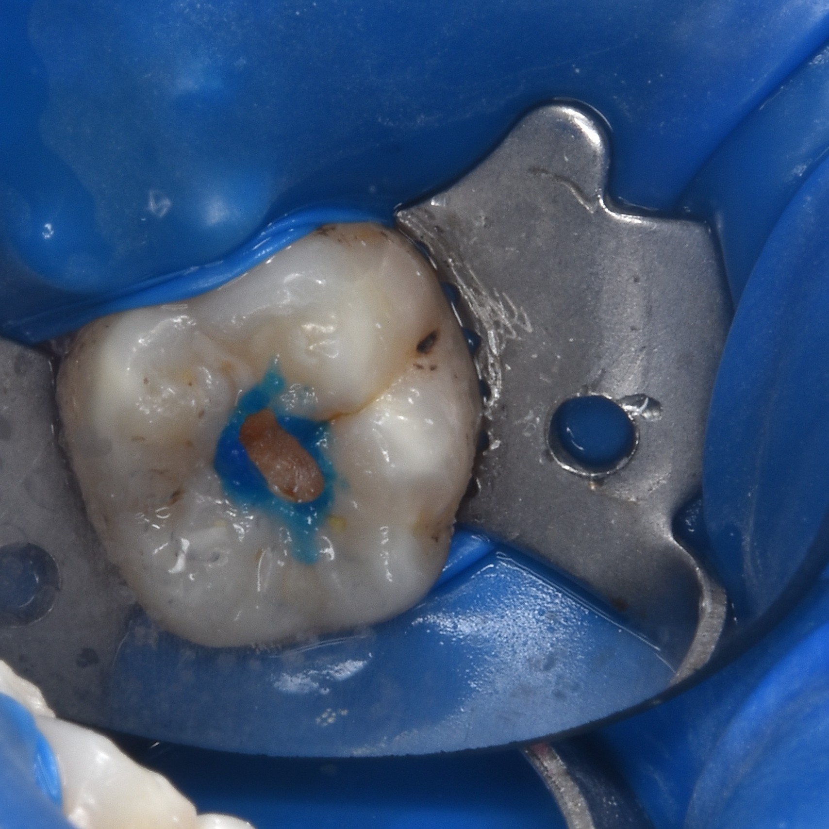 激光补牙能维持多久?价格多少