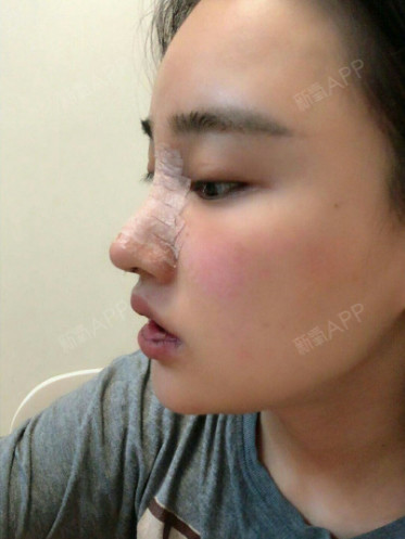 才做了一年的硅胶隆鼻部多项鼻尖就下垂了,也不知道是不_圈子-新氧