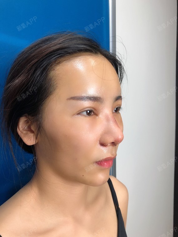 今天是我缩小鼻翼 耳软骨垫鼻尖的手术第一天,刚才医_圈子-新氧美容
